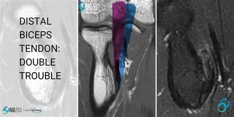 tricep tendon tear test|mri biceps tendon tear protocol.